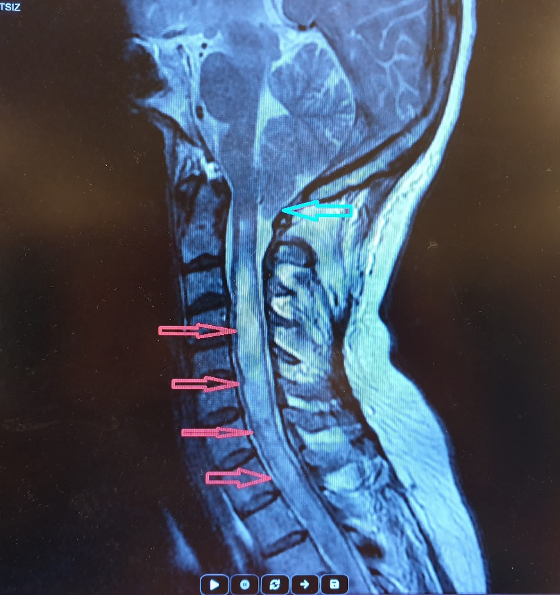 Beyincik sarkması (Arnold-chiari) hastalığı