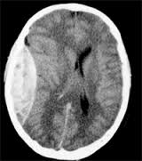 Epidural Hematom Görüntü