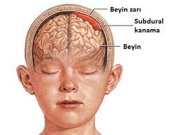 Beyin Kanamaları