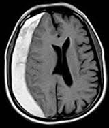 Subdural Hematom Görüntü