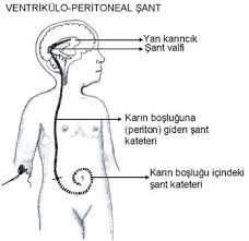 Hidrosefali Tedavi