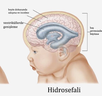 Hidrosefali (Beyinde Su Birikmesi)