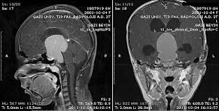 Hipofiz Adenomları